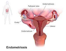 endometriosis-treatment