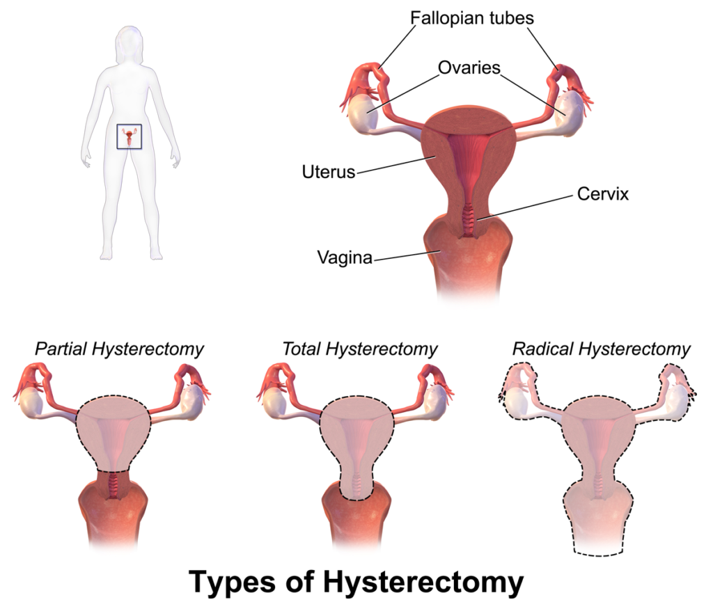 uterus-removal